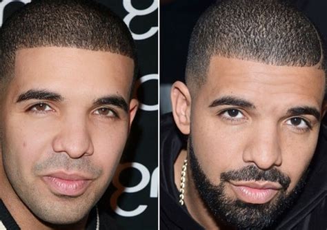 drake plastic surgery before and after|did drake get a bbl.